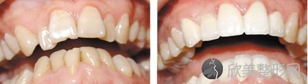 成人牙齿矫正能否快速进行 较快几天