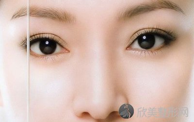 南京双眼皮手术费用多少