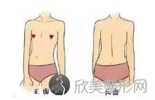 广州美莱医疗假体隆胸效果怎样