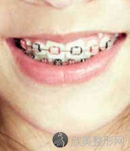 上海少儿牙齿正畸一般多少钱