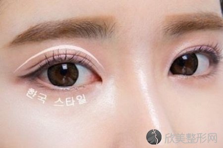 广州双眼皮能修复吗