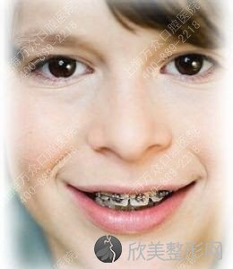 儿童牙齿矫正的最佳时期是什么时候