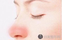 酒糟鼻怎么治疗？
