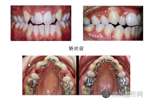 牙齿不齐用舌侧隐形矫正的优点有哪些 舌侧隐形矫正效果图