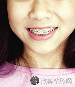 儿童牙齿排列不齐做矫正一般需要多少钱