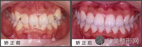 在上海成人进行牙齿矫正需要多少钱