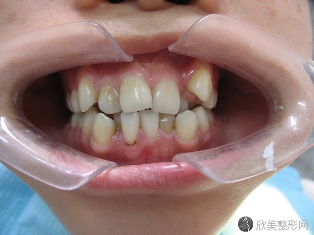 10岁的儿童牙齿不齐可不可以做牙齿矫正