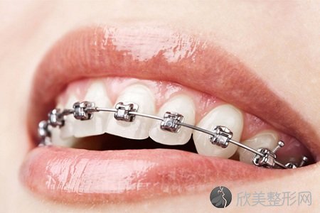 什么是牙齿嵌体修复术