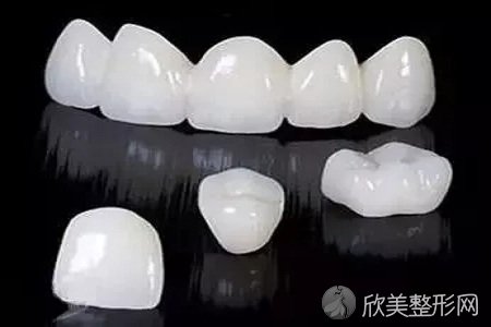 杭州做牙齿贴面铸瓷多少钱