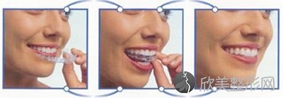 牙齿矫正选用无托槽隐形矫正有什么好处