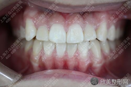 成人牙齿不整齐之牙齿矫正最佳年龄（图）
