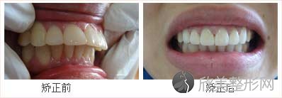 牙齿外突哪种牙齿矫正方法