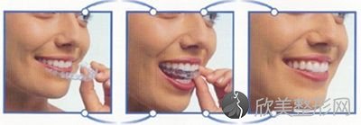 牙齿不齐做矫正使用隐形矫正有哪些优势