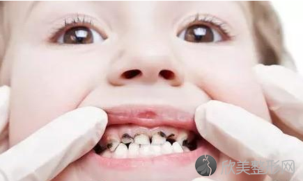 孩子牙齿矫正较佳时期