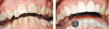 牙齿矫正对牙齿有什么影响