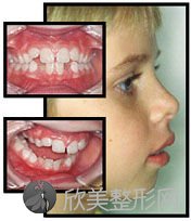 儿童牙齿矫正年龄有限制吗