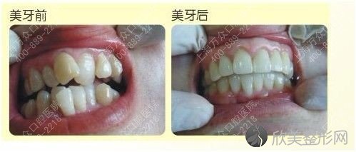 上海儿童牙齿矫正的价格怎样