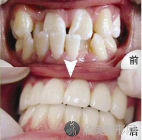 牙齿不整齐矫正牙齿的原理是什么 牙齿矫正效果图