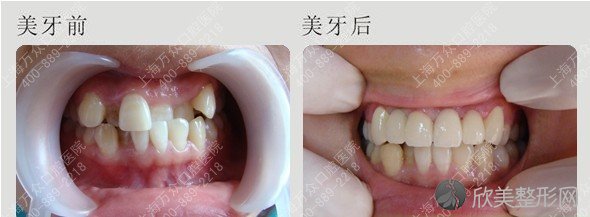上海医院成人矫正牙齿