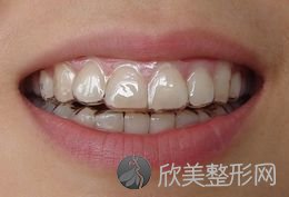 上海做牙套矫正牙齿需要多少钱