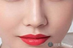 沈阳注射玻尿酸隆鼻定型要多久