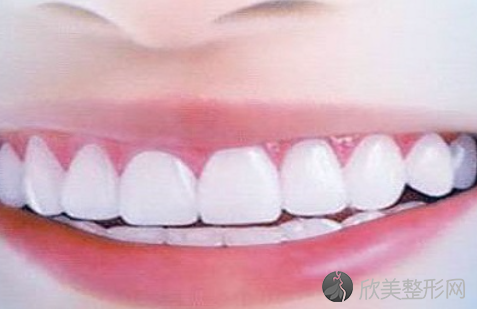 矫正牙齿多少时间能排列整齐