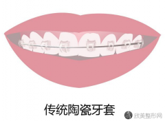 陶瓷牙套和钢牙套区别