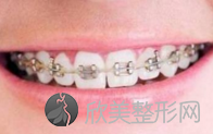 北京牙齿矫正有几种