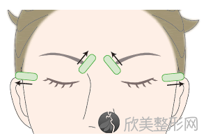 杭州做埋线双眼皮手术比割双眼皮手术好吗