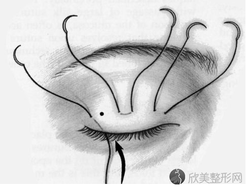郑州埋线双眼皮手术效果可以保持多久?