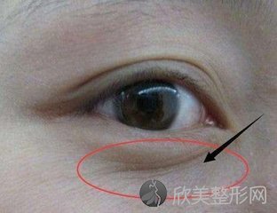 天津医院做去眼袋需要多少钱？