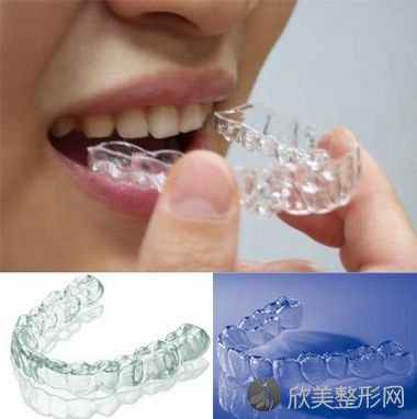 在上海进行隐形牙齿矫正一般需要多少钱