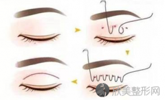 北京做双眼皮手术一般要多少钱