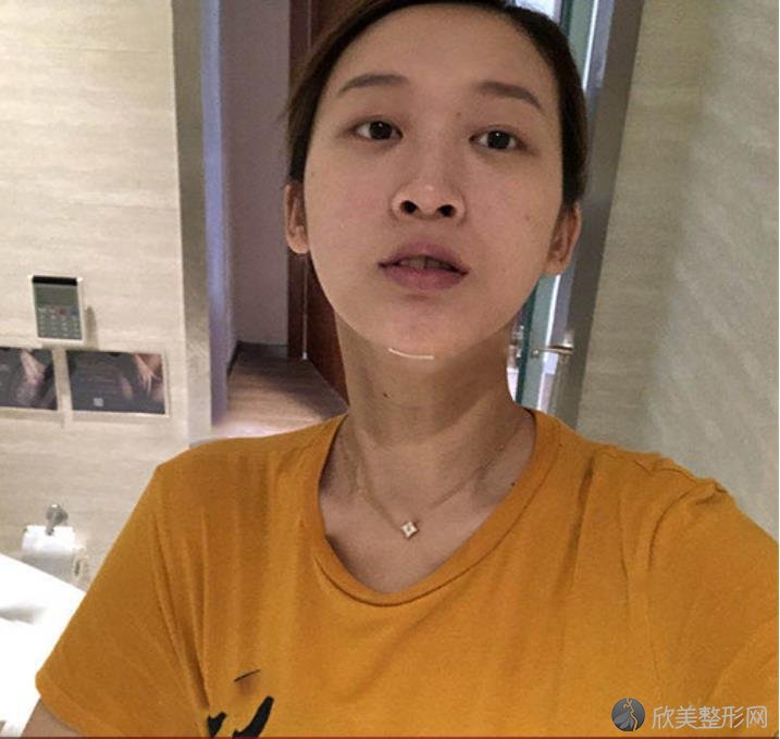 秦皇岛较好医院面部吸脂究竟怎么样？内附2021较新整形价格表分享
