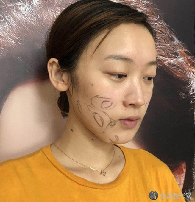 秦皇岛较好医院面部吸脂究竟怎么样？内附2021较新整形价格表分享