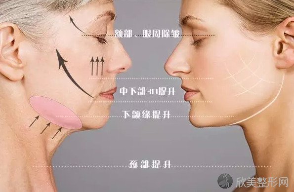 天津脸部做埋线提升后遗症有什么？