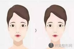 重庆注水光针效果是不是呢