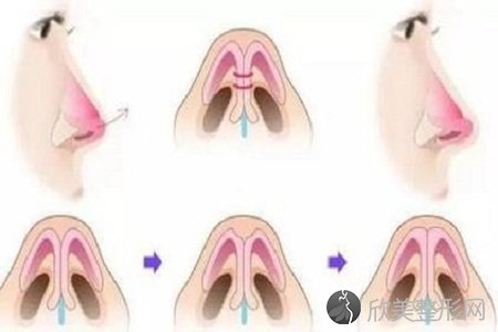 上海做玻尿酸隆鼻对身体有什么影响吗