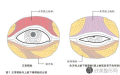 郑州做上睑下垂矫正手术哪里好