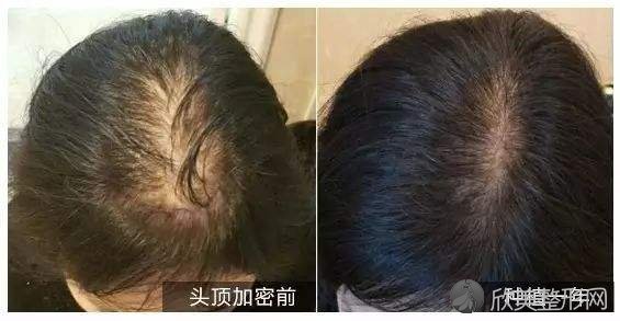 头发种植后怎么护理？