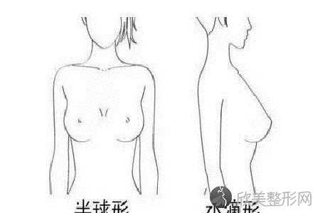 重庆做假体隆胸一般材料有哪些