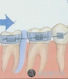 一般矫正牙齿的牙缝都要经过哪些步骤