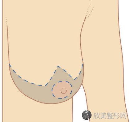 北京乳头缩小整形手术安全吗