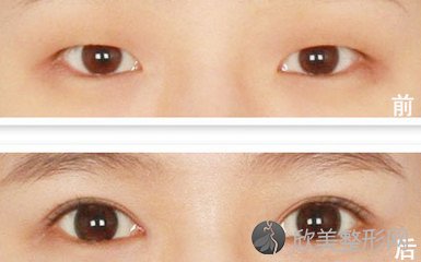 天津做双眼皮比传统双眼皮手术恢复快吗?