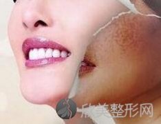 杭州怀孕了能做激光祛斑吗