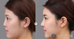自体材料鼻部整形效果能维持多久？