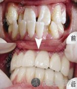 牙齿不齐易患牙病  牙齿矫正增添健康（图）