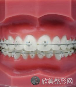 上海学生做牙齿正畸的价格一般是多少