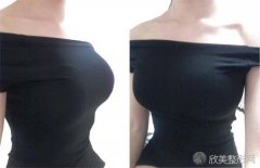南京自体脂肪隆胸手术通常需要多少钱