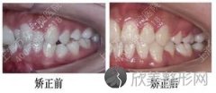 牙齿矫正 “一口歪牙变整齐”的奇迹（图）